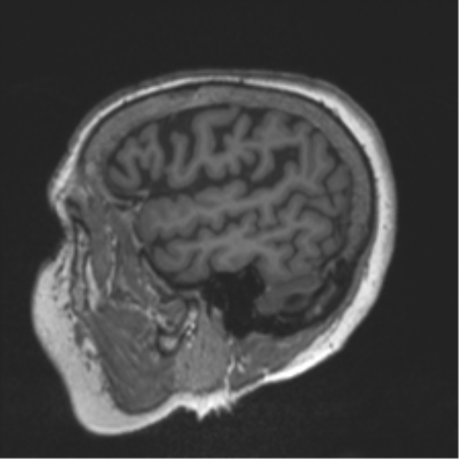 Chronic hypertensive encephalopathy (Radiopaedia 39993-42482 Sagittal T1 21).png