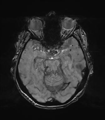 Chronic hypertensive encephalopathy (Radiopaedia 72844-83495 Axial SWI magnitude 30).png