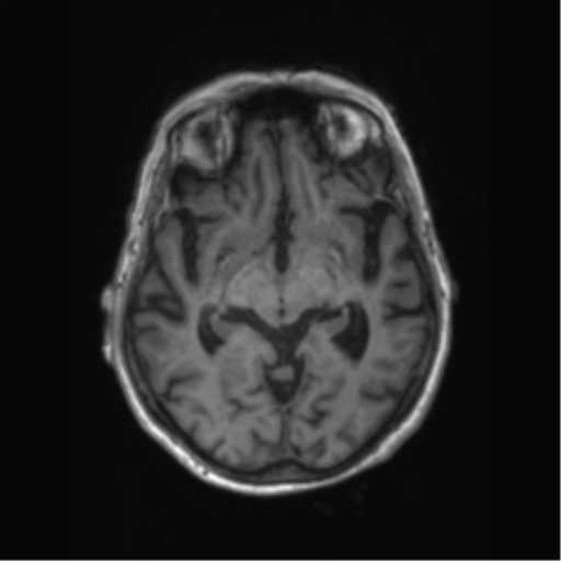 Chronic hypertensive encephalopathy (Radiopaedia 72844-83495 Axial T1 42).png