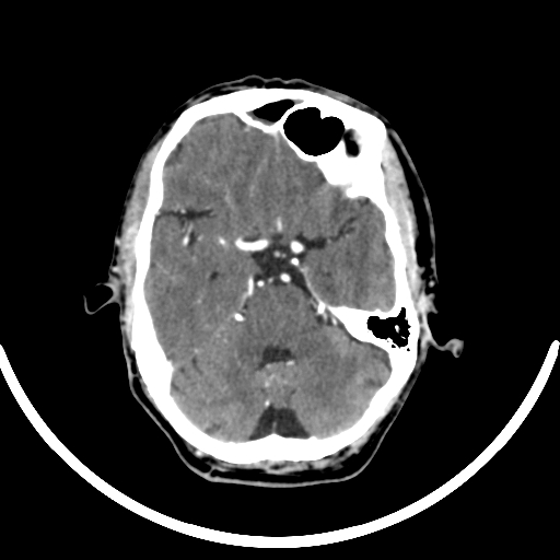 Chronic invasive fungal sinusitis with intraorbital and intracranial extension (Radiopaedia 56387-63046 B 128).jpg