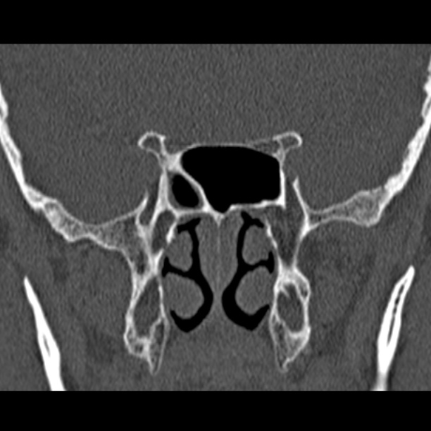 Chronic maxillary sinusitis (Radiopaedia 27879-28116 Coronal bone window 41).jpg