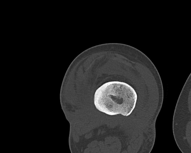 Chronic ostemyelitis of the femur with long sinus tract (Radiopaedia 74947-85982 Axial bone window 173).jpg