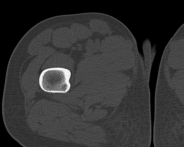 File:Chronic ostemyelitis of the femur with long sinus tract (Radiopaedia 74947-85982 Axial bone window 30).jpg