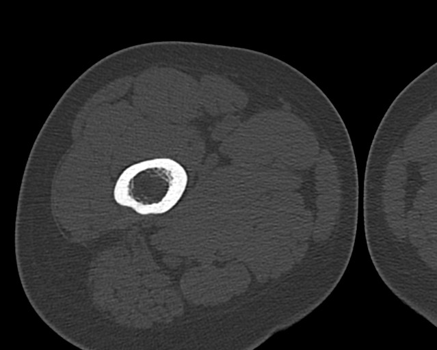 Chronic ostemyelitis of the femur with long sinus tract (Radiopaedia 74947-85982 Axial bone window 46).jpg