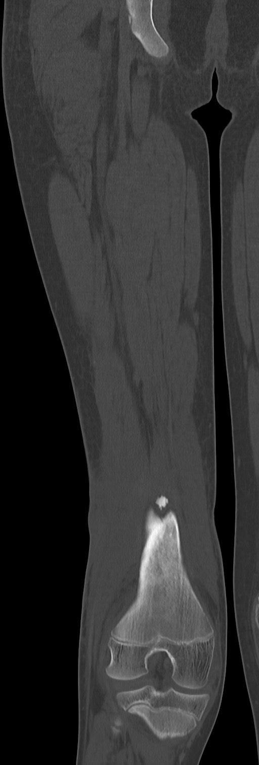 Chronic ostemyelitis of the femur with long sinus tract (Radiopaedia 74947-85982 Coronal bone window 53).jpg