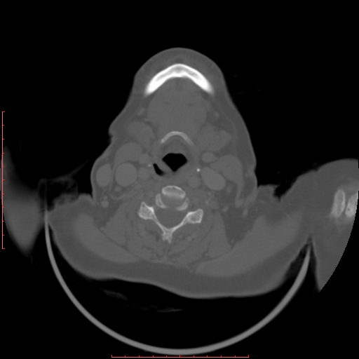 Chronic osteomyelitis - maxilla (Radiopaedia 23783-23927 Axial bone window 5).jpg