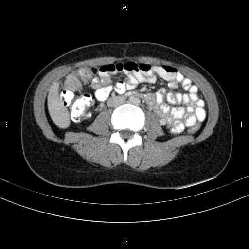 Chronic pancreatitis (Radiopaedia 64576-73450 C 93).jpg