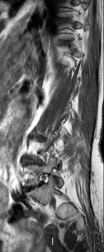 File:Chronic spinal hematoma with cauda equina syndrome (Radiopaedia 75745-87090 Sagittal T1 13).png