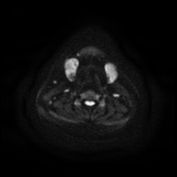 File:Chronic submandibular sialadenitis (Radiopaedia 61852-69885 Axial DWI 18).jpg