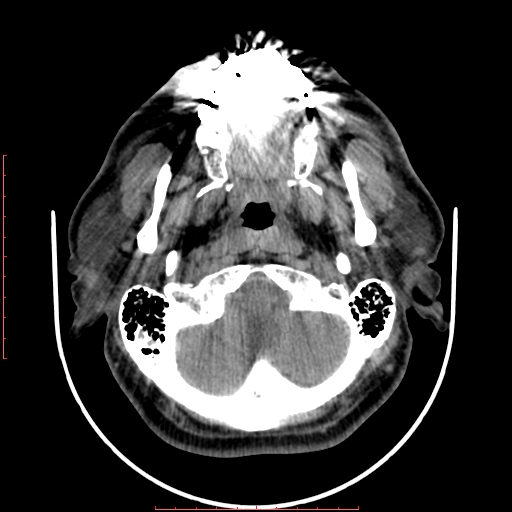 Chronic submandibular sialolithiasis (Radiopaedia 69817-79814 Axial non-contrast 40).jpg
