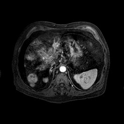 File:Cirrhosis and hepatocellular carcinoma in the setting of hemochromatosis (Radiopaedia 75394-86594 Axial T1 C+ fat sat 135).jpg
