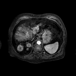 Cirrhosis and hepatocellular carcinoma in the setting of hemochromatosis (Radiopaedia 75394-86594 Axial T1 C+ fat sat 140).jpg