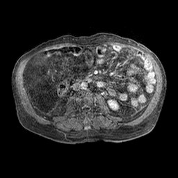 File:Cirrhosis and hepatocellular carcinoma in the setting of hemochromatosis (Radiopaedia 75394-86594 Axial T1 C+ fat sat 263).jpg