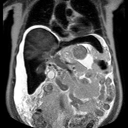 File:Cirrhosis and hepatocellular carcinoma in the setting of hemochromatosis (Radiopaedia 75394-86594 Coronal T2 13).jpg