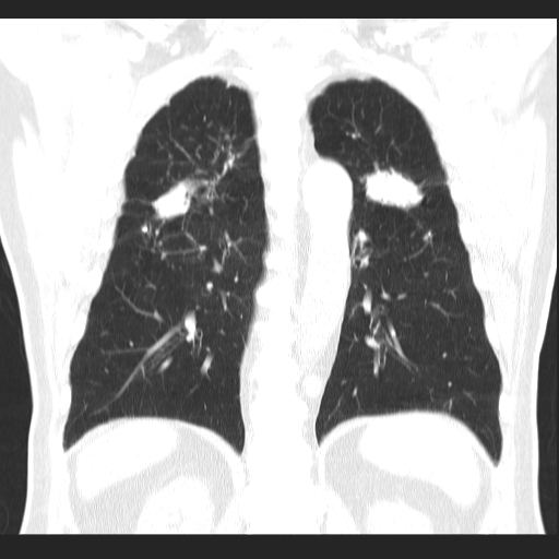 File:Classic complicated silicosis (Radiopaedia 49720-54961 Coronal lung window 43).jpg