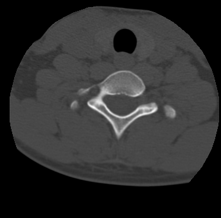 Clay-shoveler fracture (Radiopaedia 22568-22590 Axial bone window 61).jpg