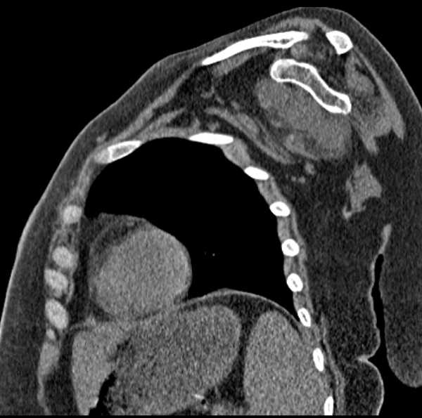 Clear cell chondrosarcoma - humerus (Radiopaedia 63104-71612 D 39).jpg