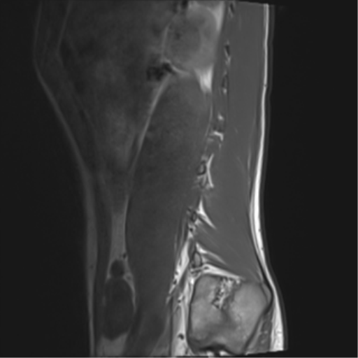 File:Clear cell meningoma - lumbar spine (Radiopaedia 60116-67690 Sagittal T1 1).png