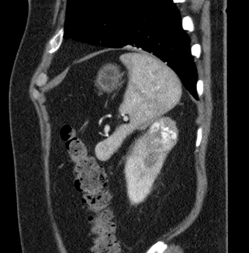 File:Clear cell renal cell carcinoma (Radiopaedia 61449-69393 D 9).jpg