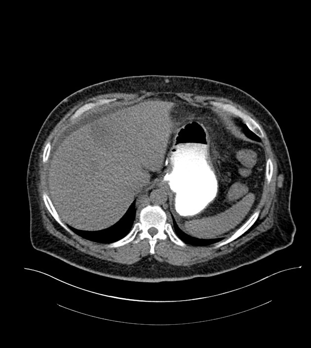 Closed-loop small bowel obstruction-internal hernia (Radiopaedia 78439-91096 Axial non-contrast 28).jpg