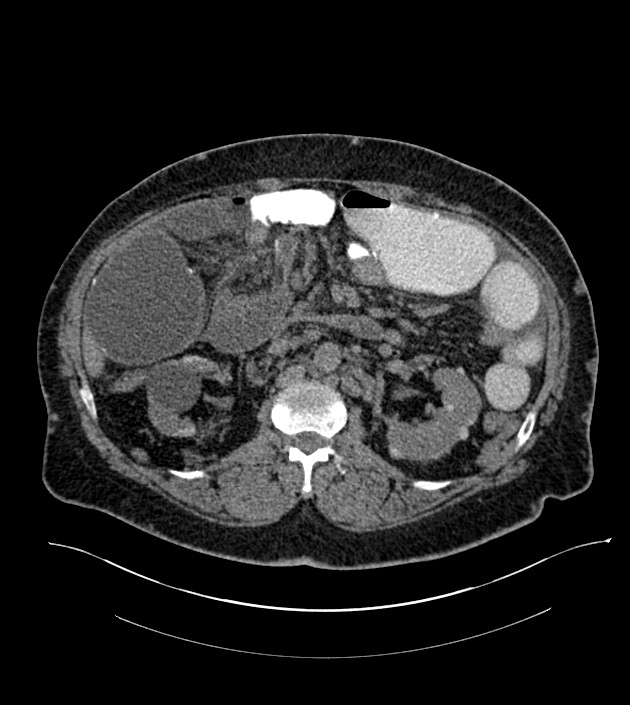 Closed-loop small bowel obstruction-internal hernia (Radiopaedia 78439-91096 Axial non-contrast 65).jpg