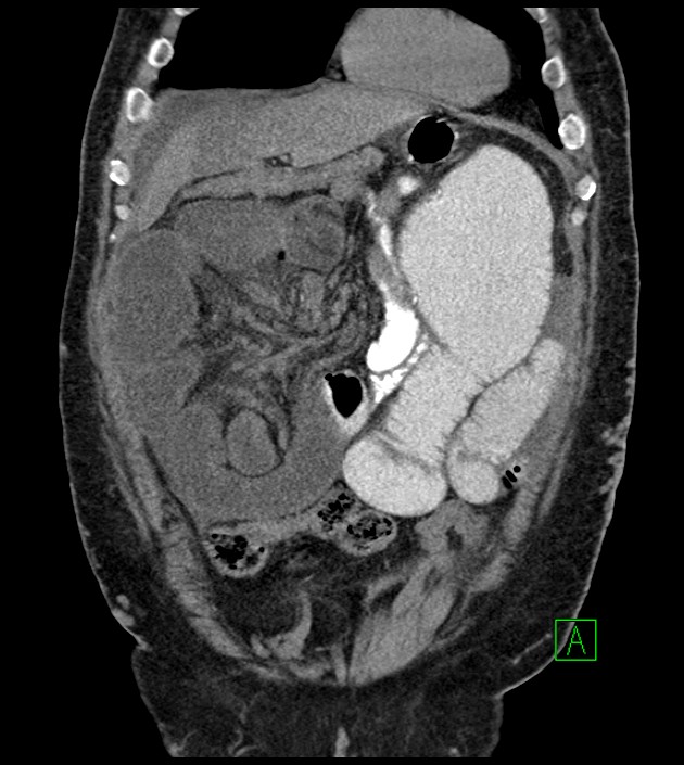 Closed-loop small bowel obstruction-internal hernia (Radiopaedia 78439-91096 Coronal non-contrast 32).jpg