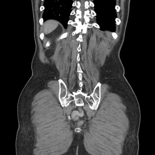 File:Closed loop obstruction due to adhesive band, resulting in small bowel ischemia and resection (Radiopaedia 83835-99023 C 106).jpg