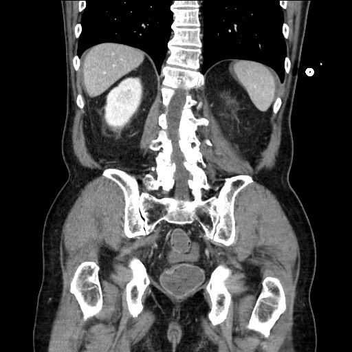Closed loop obstruction due to adhesive band, resulting in small bowel ischemia and resection (Radiopaedia 83835-99023 E 96).jpg