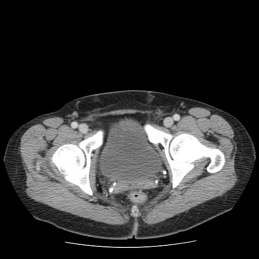File:Closed loop small bowel obstruction (Radiopaedia 65403-74451 Axial 60).jpg