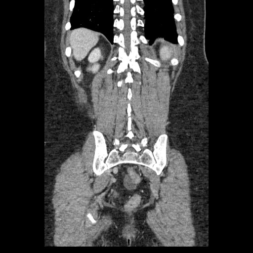 Closed loop small bowel obstruction (Radiopaedia 65403-74451 B 85).jpg