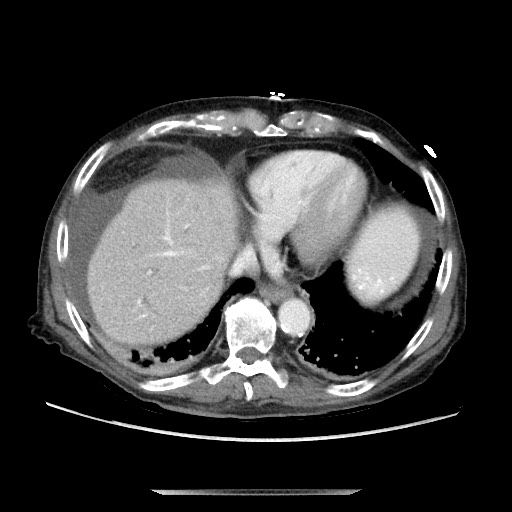 File:Closed loop small bowel obstruction - adhesive disease and hemorrhagic ischemia (Radiopaedia 86831-102990 A 34).jpg