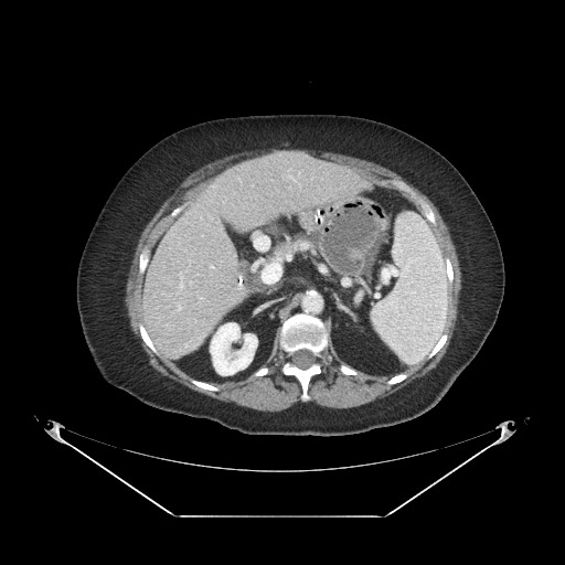Closed loop small bowel obstruction - internal hernia (Radiopaedia 65402-74450 A 35).jpg