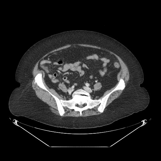 File:Closed loop small bowel obstruction - internal hernia (Radiopaedia 65402-74450 A 92).jpg