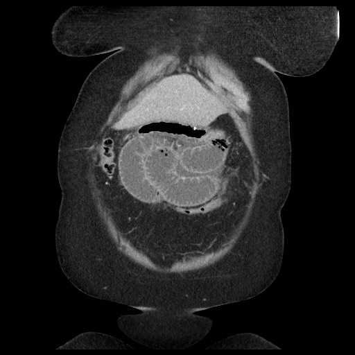 Closed loop small bowel obstruction - internal hernia (Radiopaedia 65402-74450 B 20).jpg