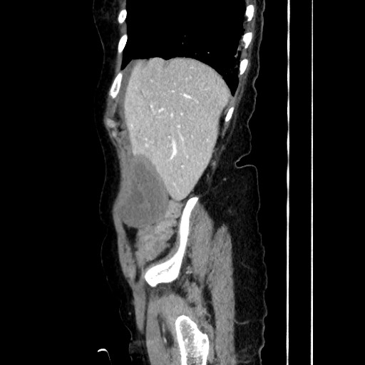 Closed loop small bowel obstruction due to adhesive band, with intramural hemorrhage and ischemia (Radiopaedia 83831-99017 D 54).jpg