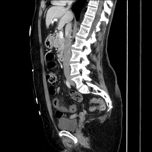 Closed loop small bowel obstruction due to adhesive bands - early and late images (Radiopaedia 83830-99014 C 87).jpg