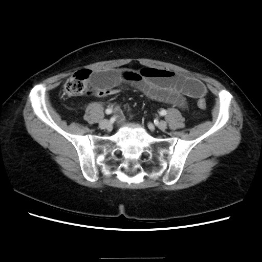Closed loop small bowel obstruction due to adhesive bands - early and late images (Radiopaedia 83830-99015 A 122).jpg