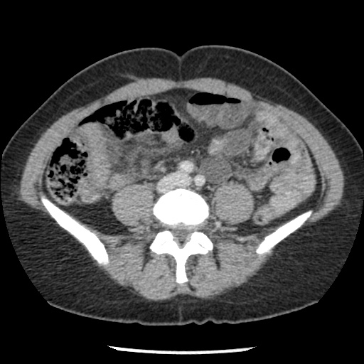 File:Closed loop small bowel obstruction due to trans-omental herniation (Radiopaedia 35593-37109 A 54).jpg