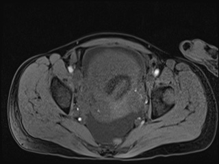 File:Closed loop small bowel obstruction in pregnancy (MRI) (Radiopaedia 87637-104031 G 9).jpg