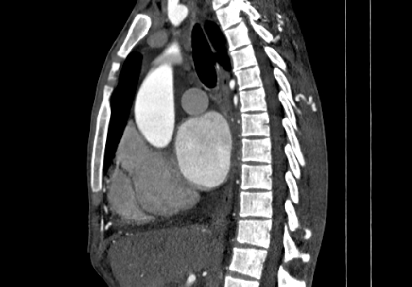 Coarctation of aorta with aortic valve stenosis (Radiopaedia 70463-80574 B 46).jpg