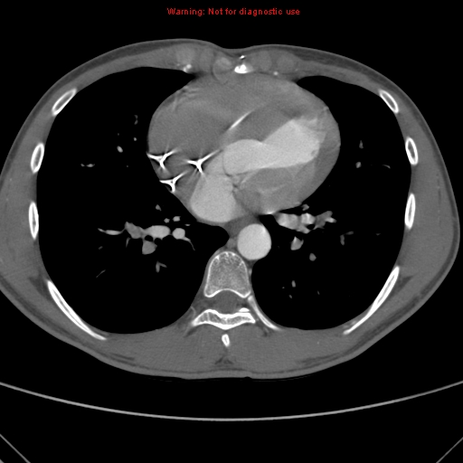 File:Coarctation of the aorta (Radiopaedia 9434-10118 A 119).jpg