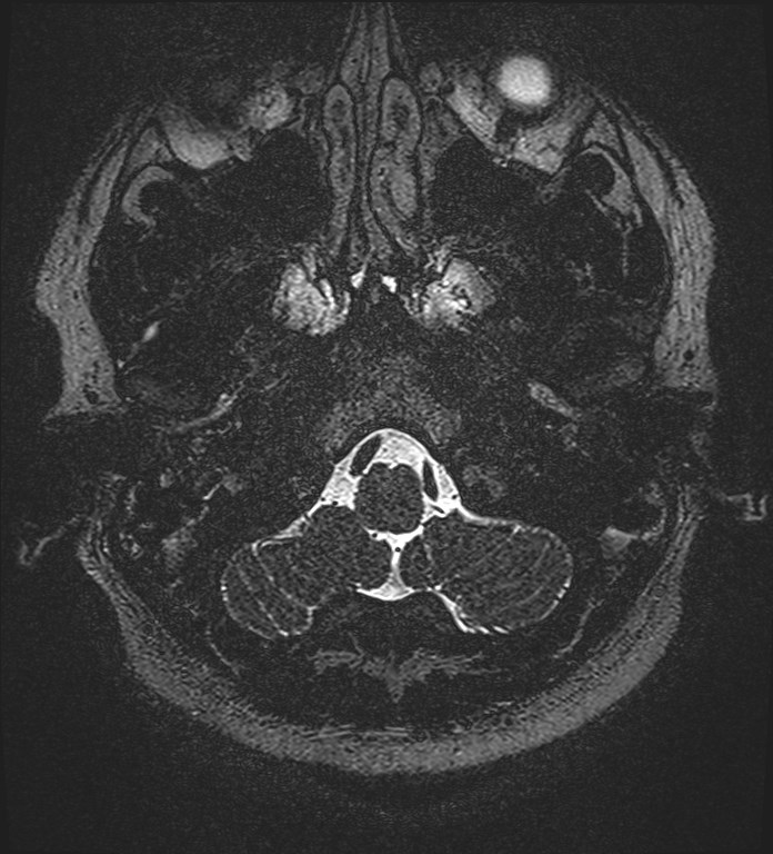 Cochlear incomplete partition type III associated with hypothalamic hamartoma (Radiopaedia 88756-105498 Axial T2 20).jpg