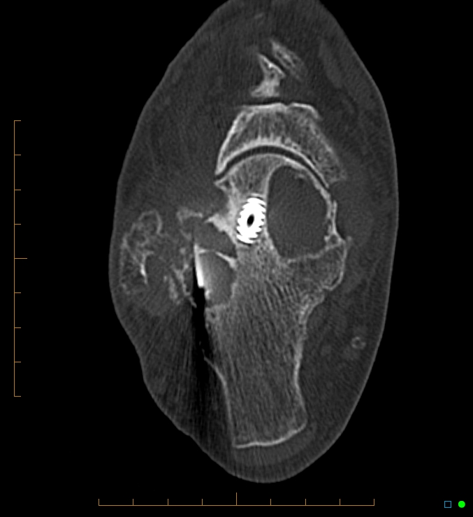 Collapsed total ankle replacement (Radiopaedia 17228-16932 Axial bone window 46).jpg