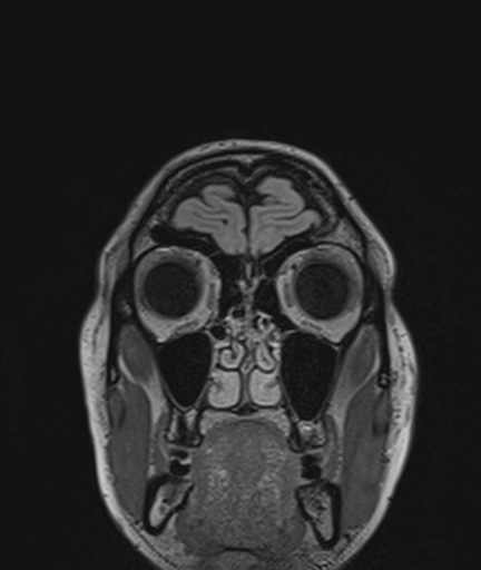 Colloid cyst (Radiopaedia 73154-83877 Coronal FLAIR 5).jpg
