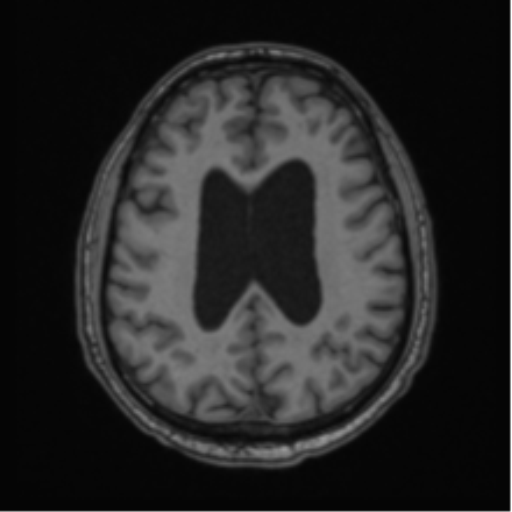 File:Colloid cyst of the third ventricle (Radiopaedia 86571-102662 Axial T1 53).png