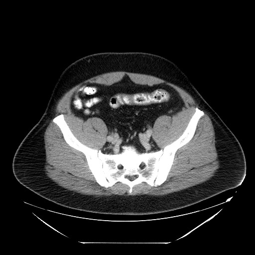 Colocolic intussusception due to lipoma (Radiopaedia 73712-84508 A 92).jpg