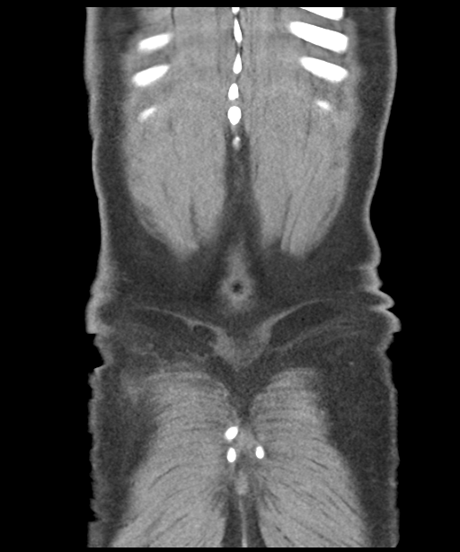 Colon adenocarcinoma - splenic flexure (Radiopaedia 34143-35406 B 61).png