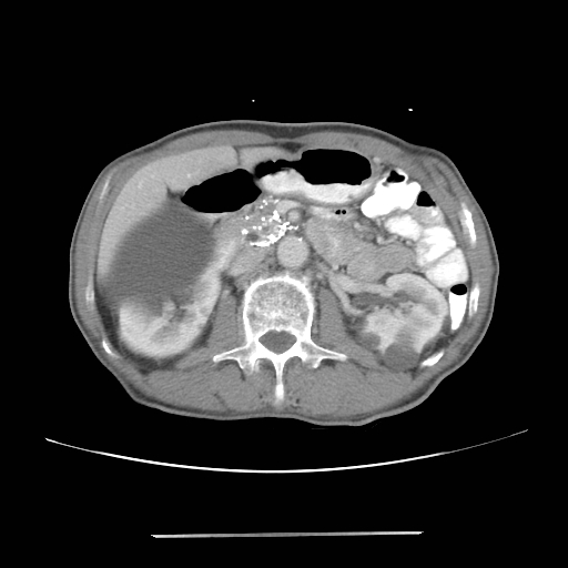 Colon cancer with calcified liver metastasis (Radiopaedia 74423-85307 A 30).jpg