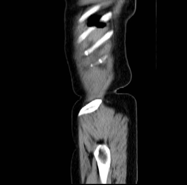 Colon carcinoma with hepatic metastases (Radiopaedia 29477-29961 C 3).jpg