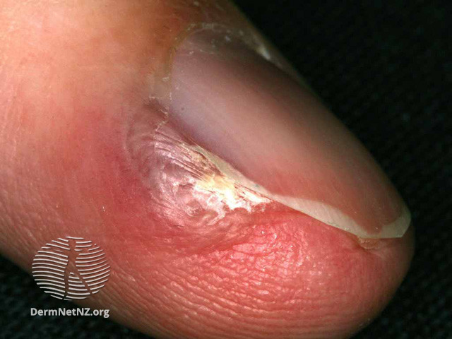 File:Glomus tumour (DermNet NZ vascular-glomus).jpg